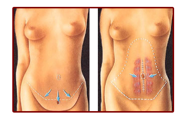 Picture of before and after tummy tuck procedure