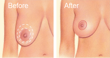 Picture of a breast lift procedure
