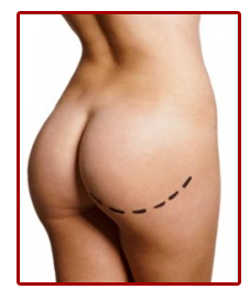 Picture of a well shaped buttocks implants