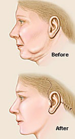 Picture of a face lift procedure