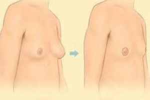 Image of before and after gynecomastia procedure