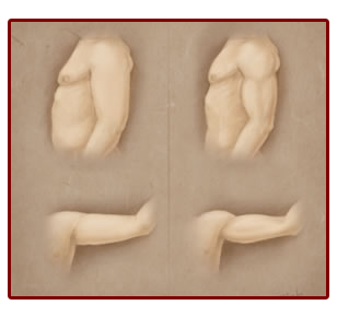 Set of 4 images with before and after liposuctioned areas