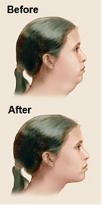 Picture of a neck sculpting procedure
