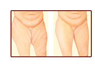 Picture of before and after thigh lift procedure